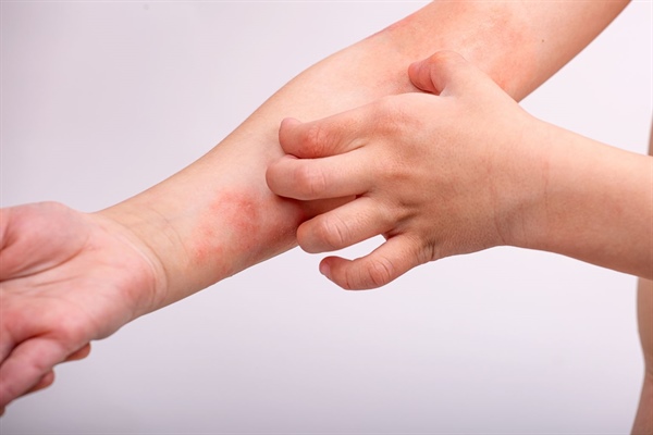 Study shows limited benefits of elimination diets for children with atopic dermatitis