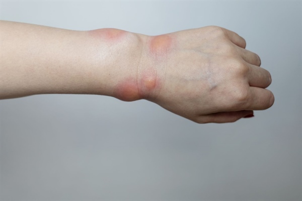 Stinging Insect Allergy Can Ruin Outdoor Activities